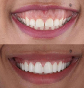 Gummy Smile Correction